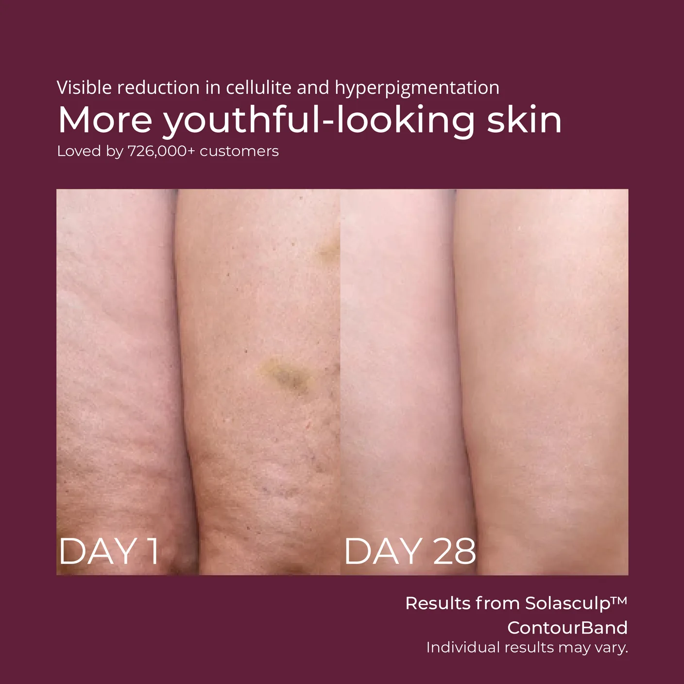 Thigh texture, day 1 and day 28