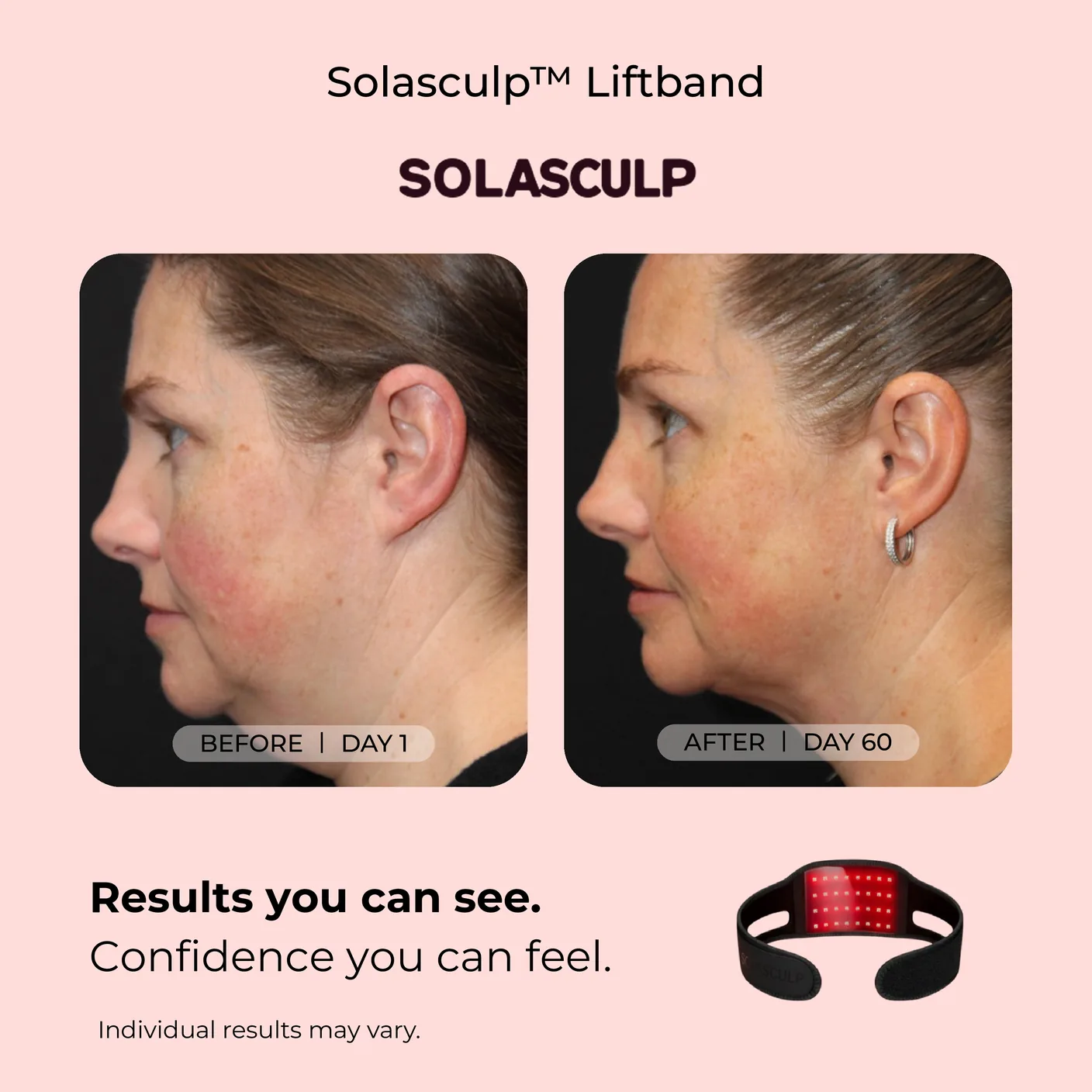 Jawline before and after, day 1 and day 60